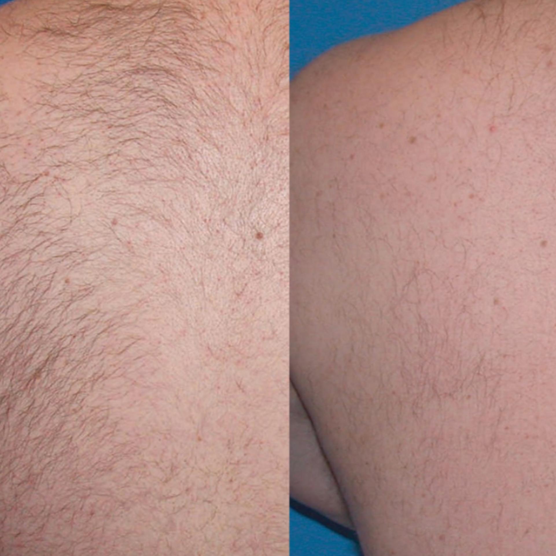 Epilazione laser peli