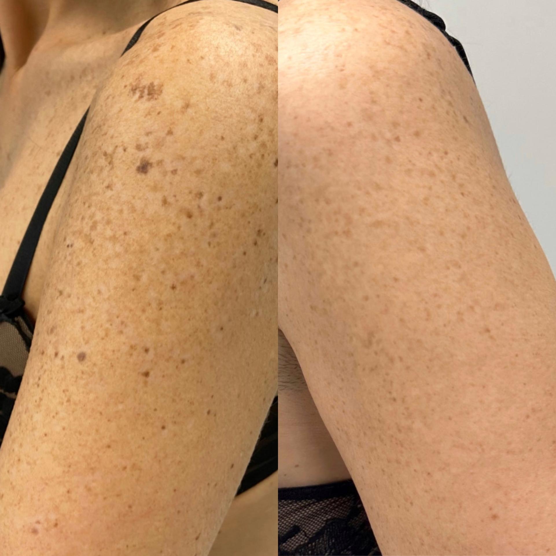 rimozione macchie solari