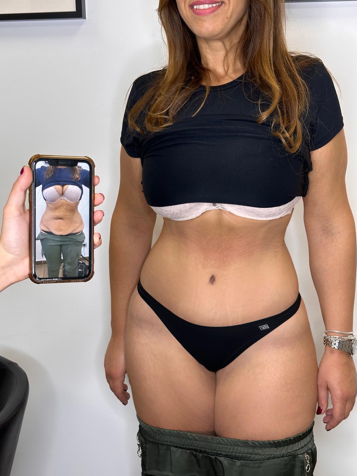 risulatato addominoplastica scalera