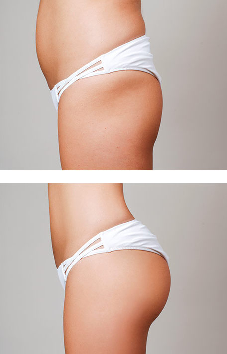 lipofilling-glutei-prima