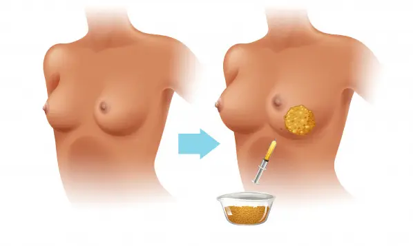 lipofilling-seno-dr-scalera