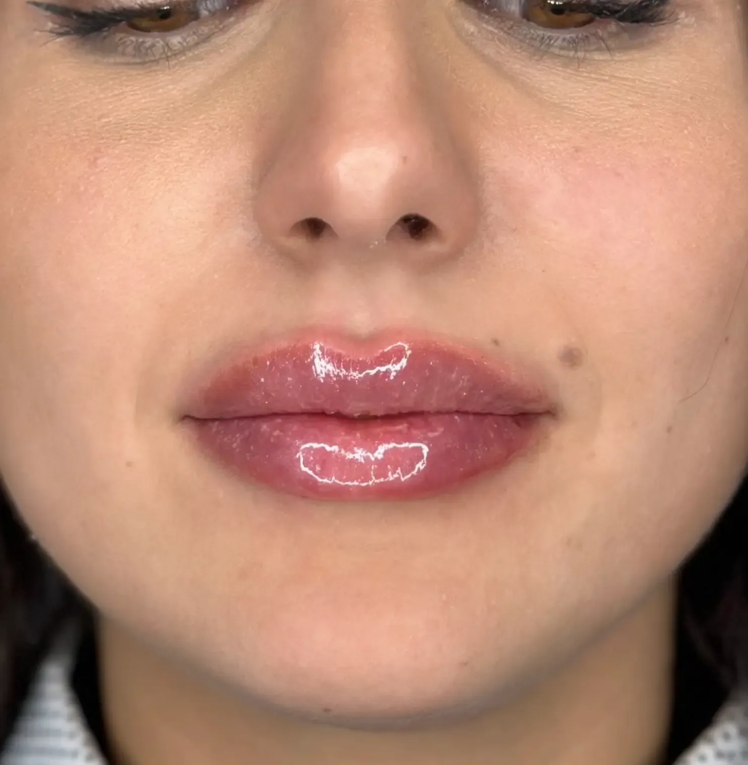 risultato-labbra-dopo
