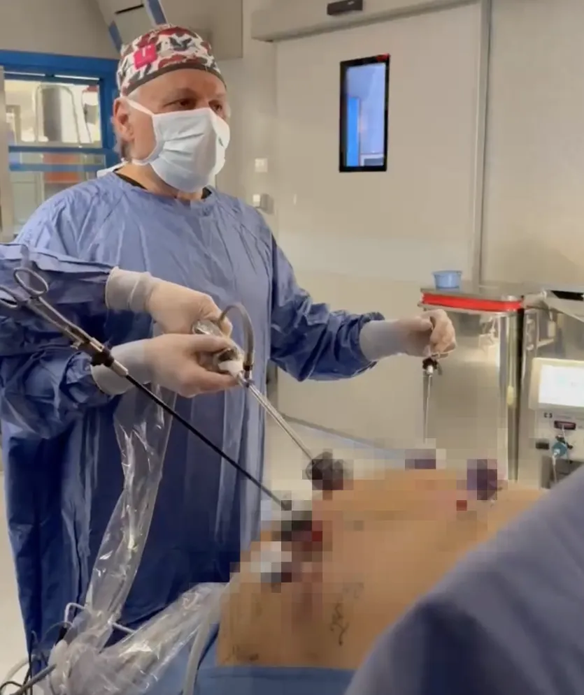 sleeve- riduzione-stomaco