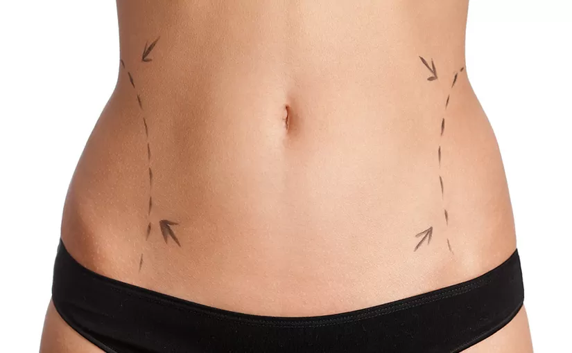 vaser lipo scalera napoli